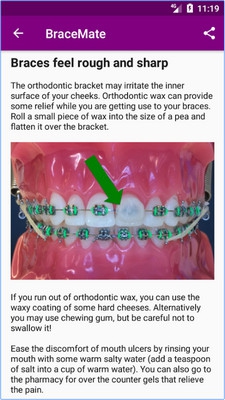 BraceMate (App ไอเดียเลือกสียางจัดฟัน ในการดัดฟัน) : 