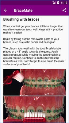 BraceMate (App ไอเดียเลือกสียางจัดฟัน ในการดัดฟัน) : 